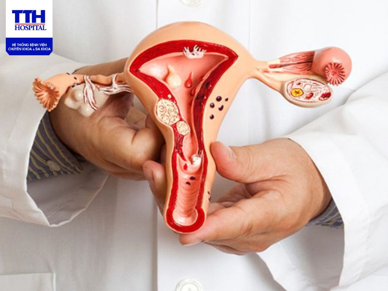 U nang buồng trứng là gì? Nguyên nhân, triệu chứng, chẩn đoán và cách điều trị